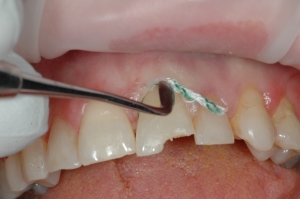 A retraction cord (GingiBRAID+ #2, Dux Dental, Oxnard, CA) was placed to isolate tooth #9 prior to treatment. 