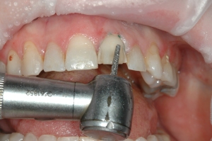FIGURE 3: Tooth #9 was prepared for the veneer restoration. 