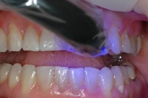 FIGURE 8: The restoration was seated into place using an esthetic luting composite (Varliolink Veneer, Ivoclar Vivadent) and cured using an LED curing light (Bluephase, Ivocalr Vivadent); no contact adjustment was necessary due to the accuracy of impression. 